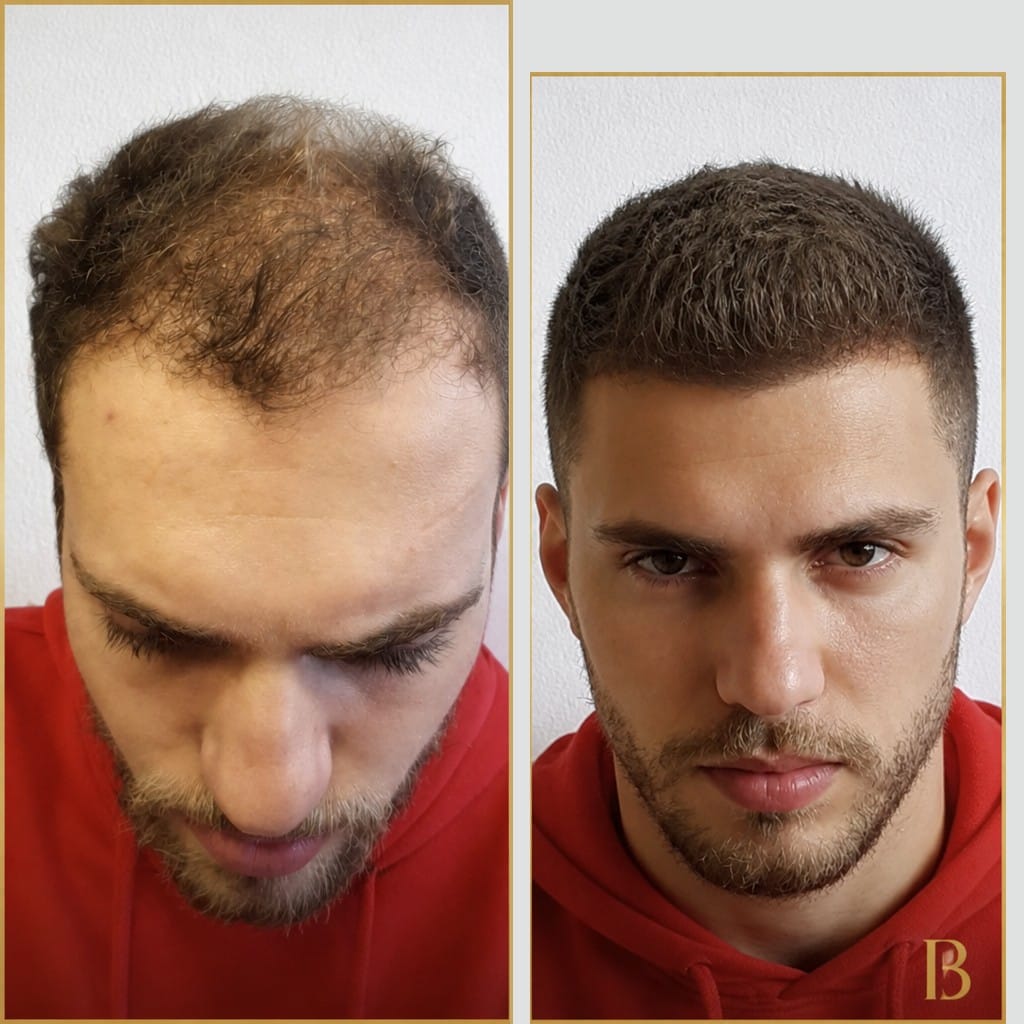 Hair restoration — lived-in result