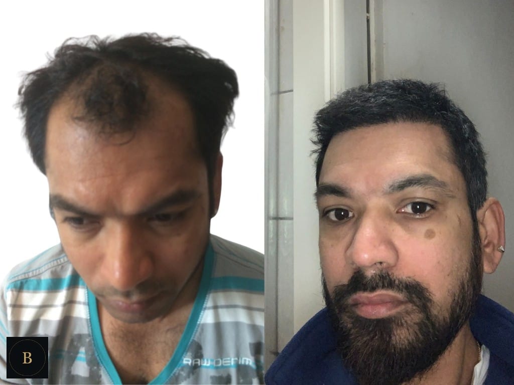 Hair restoration — lived-in result