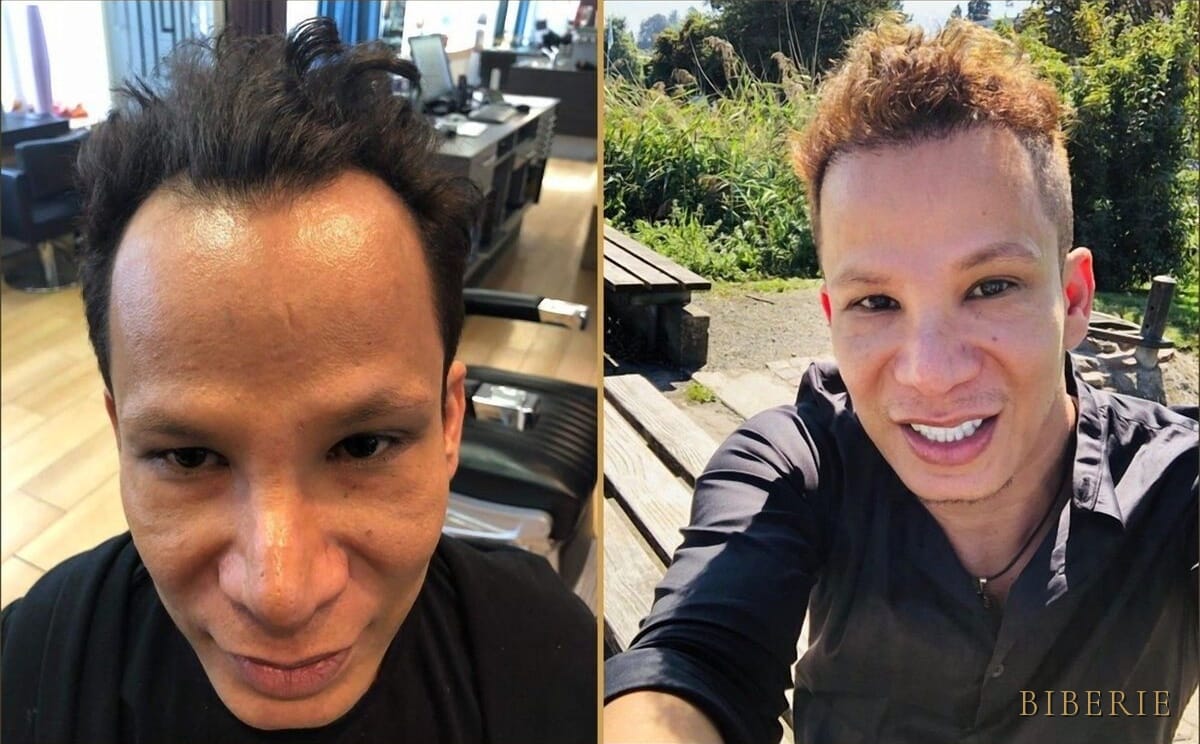 Hair restoration — lived-in result