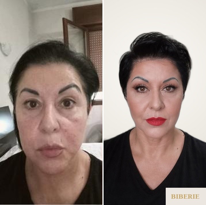 Facelift — lived-in result